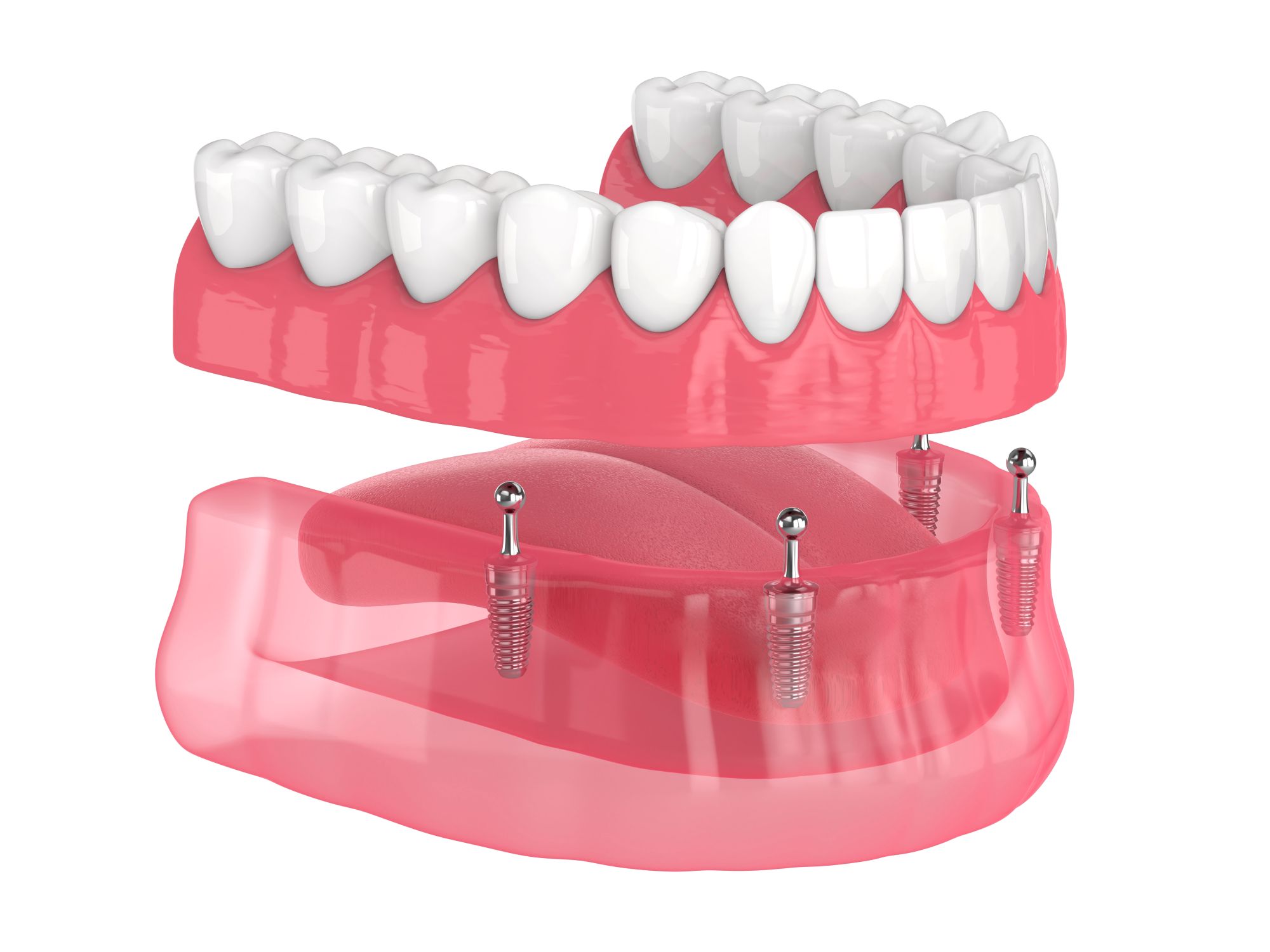 Implant Suported Denture Compressed