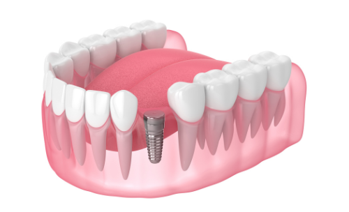 Simgle Tooth Implant Web